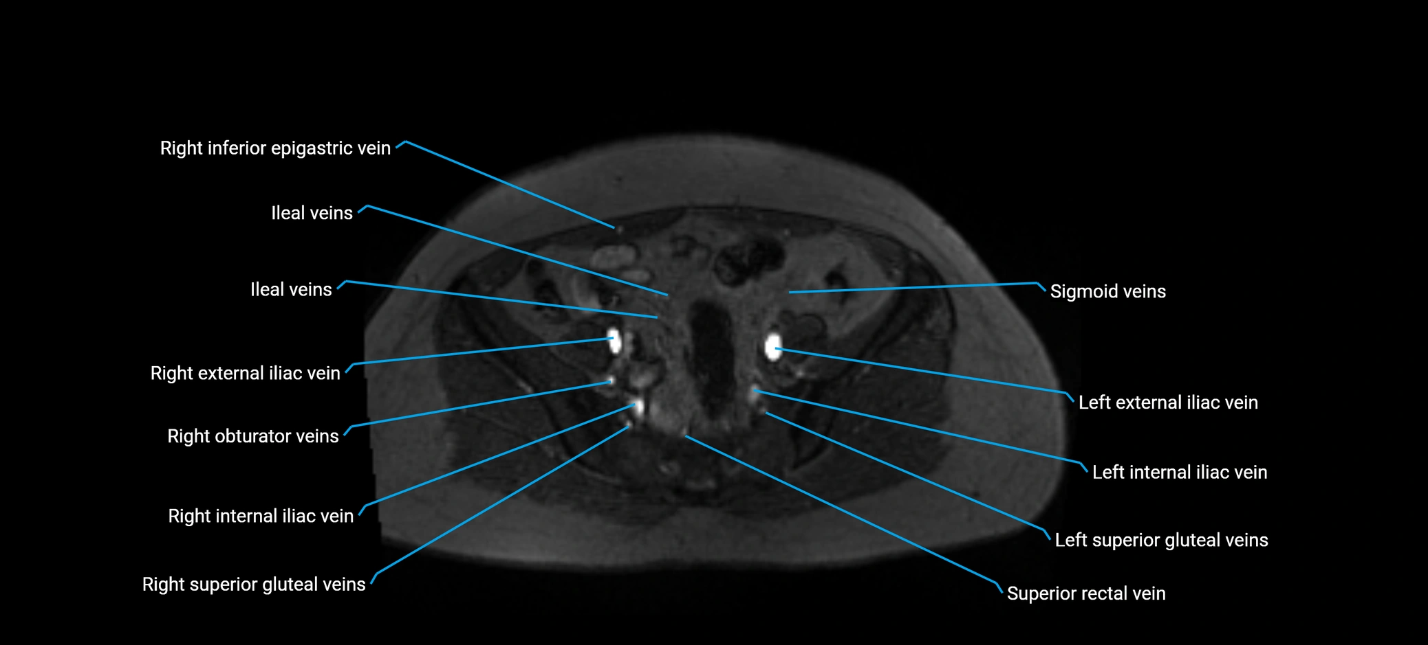 MRV abdomen pelvis & lower limb axial cross sectional anatomy labelled MRI image 142 (1).webp